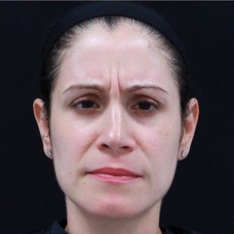 38 year old female treated with Botox before 3724503
