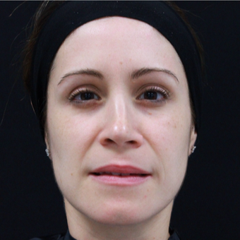 38 year old female treated with Botox after 3724503