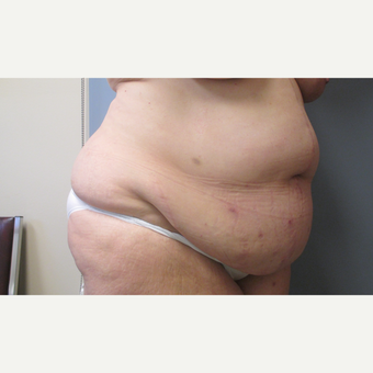 45-54 year old woman treated with Tummy Tuck before 3108127
