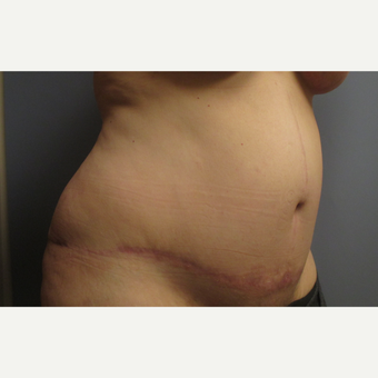 45-54 year old woman treated with Tummy Tuck after 3108127