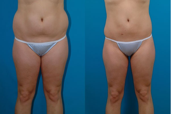 22-year-old woman treated with Liposuction. before 574526