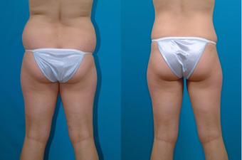 22-year-old woman treated with Liposuction. after 574526