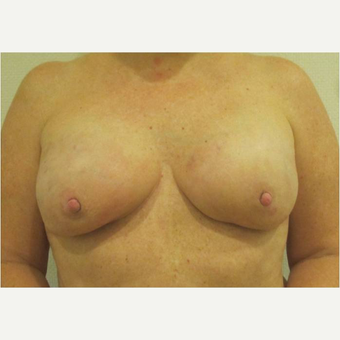 45-54 year old woman treated with Breast Reconstruction after 3744674