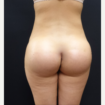 25-34 year old woman treated with Butt Lift using 712cc Round Silicone Butt Implants after 3259563