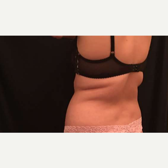 18-24 year old woman treated with CoolSculpting before 3747863