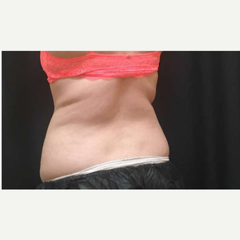 18-24 year old woman treated with CoolSculpting after 3747863