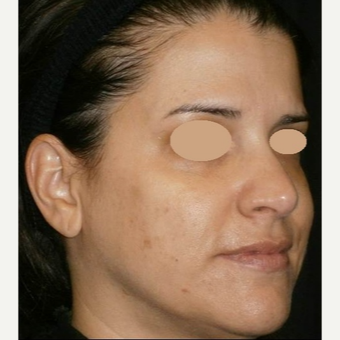 35-44 year old woman treated with IPL after 3153451