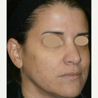 35-44 year old woman treated with IPL before 3153451