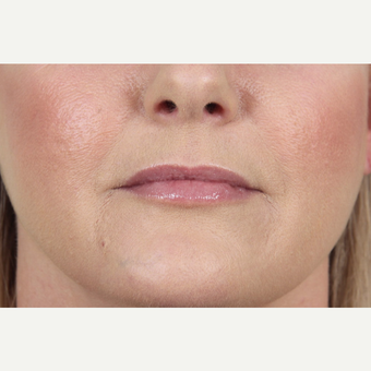 45-54 year old woman treated with Juvederm to her lips and marionette lines after 3345159