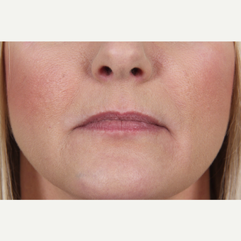 45-54 year old woman treated with Juvederm to her lips and marionette lines before 3345159