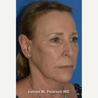 55-64 year old woman treated with Facelift before 3802260