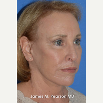 55-64 year old woman treated with Facelift after 3802260