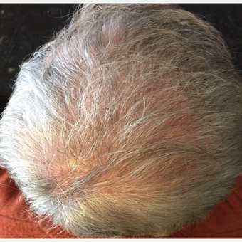 45-54 year old man treated with NeoGraft after 3696654