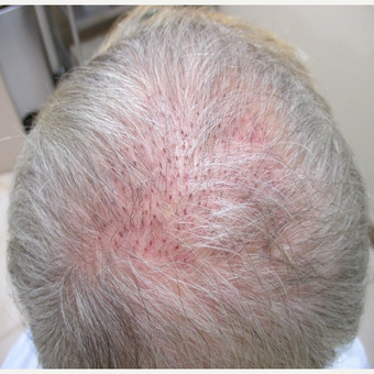 45-54 year old man treated with NeoGraft before 3696654