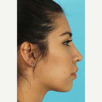 25-34 year old woman treated with Rhinoplasty after 3691046