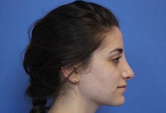 19 Year Old Treated for Aesthetic Nasal Deformity after 709830