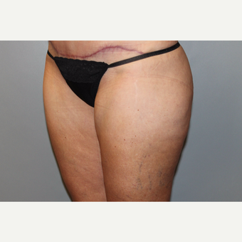 45-54 year old woman treated with Liposuction after 3588284