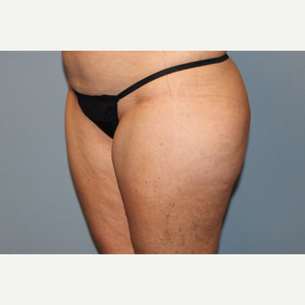 45-54 year old woman treated with Liposuction before 3588284