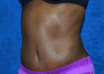 African American Tummy Tuck 1392936