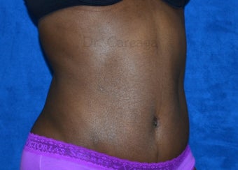 African American Tummy Tuck after 1392936
