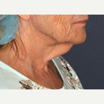 65 year old woman treated with ThermiTight before 1645287