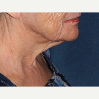 65 year old woman treated with ThermiTight after 1645287