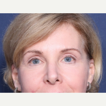 55-64 year old woman treated with Eyelid Surgery (view 1 of 2) after 3180959