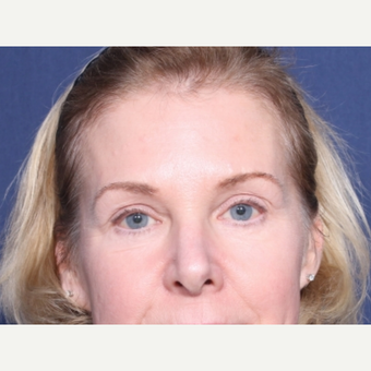 55-64 year old woman treated with Eyelid Surgery (view 1 of 2) before 3180959