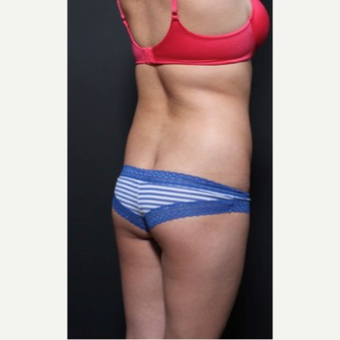 25-34 year old woman treated with Brazilian Butt Lift before 3065681