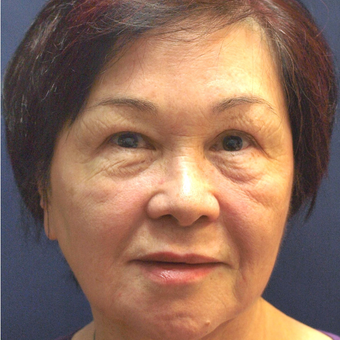 45-54 year old woman treated with Fraxel Laser after 3201914