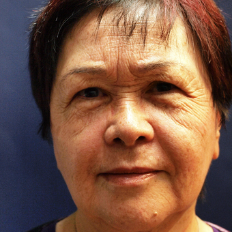 45-54 year old woman treated with Fraxel Laser before 3201914