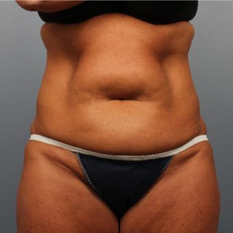 45-54 year old woman treated with CoolSculpting before 3507391