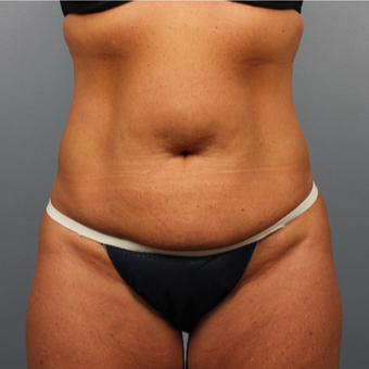 45-54 year old woman treated with CoolSculpting after 3507391