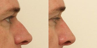 Rhinoplasty without surgery before 922046