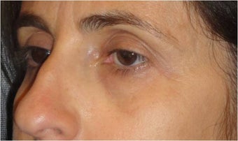 Restylane before 699741