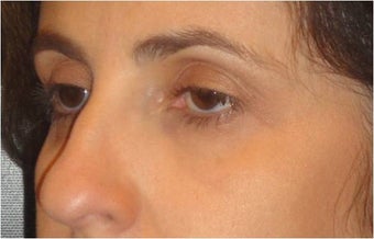Restylane after 699741