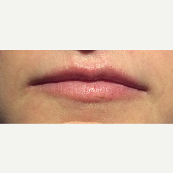 35-44 year old woman treated with Lip Augmentation before 3470324