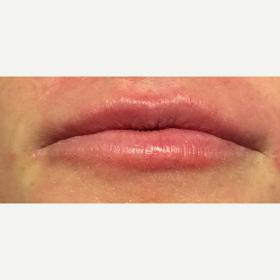 35-44 year old woman treated with Lip Augmentation after 3470324
