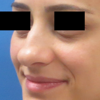 25-34 year old woman treated with Rhinoplasty before 2919712