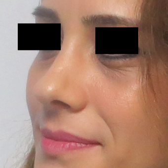25-34 year old woman treated with Rhinoplasty after 2919712