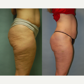 49 year-old woman seven months post Cellulaze and Smartlipo for buttocks, posterior thighs and hips after 3261922