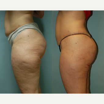 49 year-old woman seven months post Cellulaze and Smartlipo for buttocks, posterior thighs and hips before 3261922