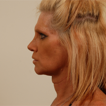 50 year old transgender woman underwent Facial Feminization Surgery before 3109957