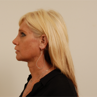 50 year old transgender woman underwent Facial Feminization Surgery after 3109957