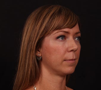 35-44 year old woman treated with Lip Lift 3671229