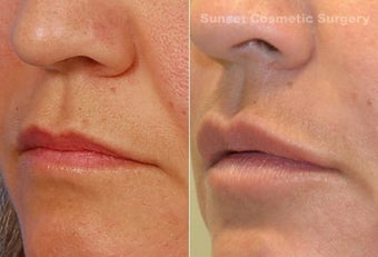 Juvederm - Lips, Nasolabial Folds after 1099859