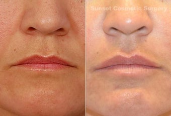 Juvederm - Lips, Nasolabial Folds before 1099859