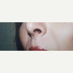 25-34 year old man treated with Facial Feminization Surgery after 1623736