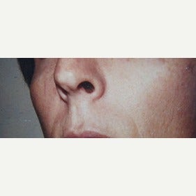 25-34 year old man treated with Facial Feminization Surgery before 1623736
