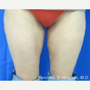 Liposuction after 3094225